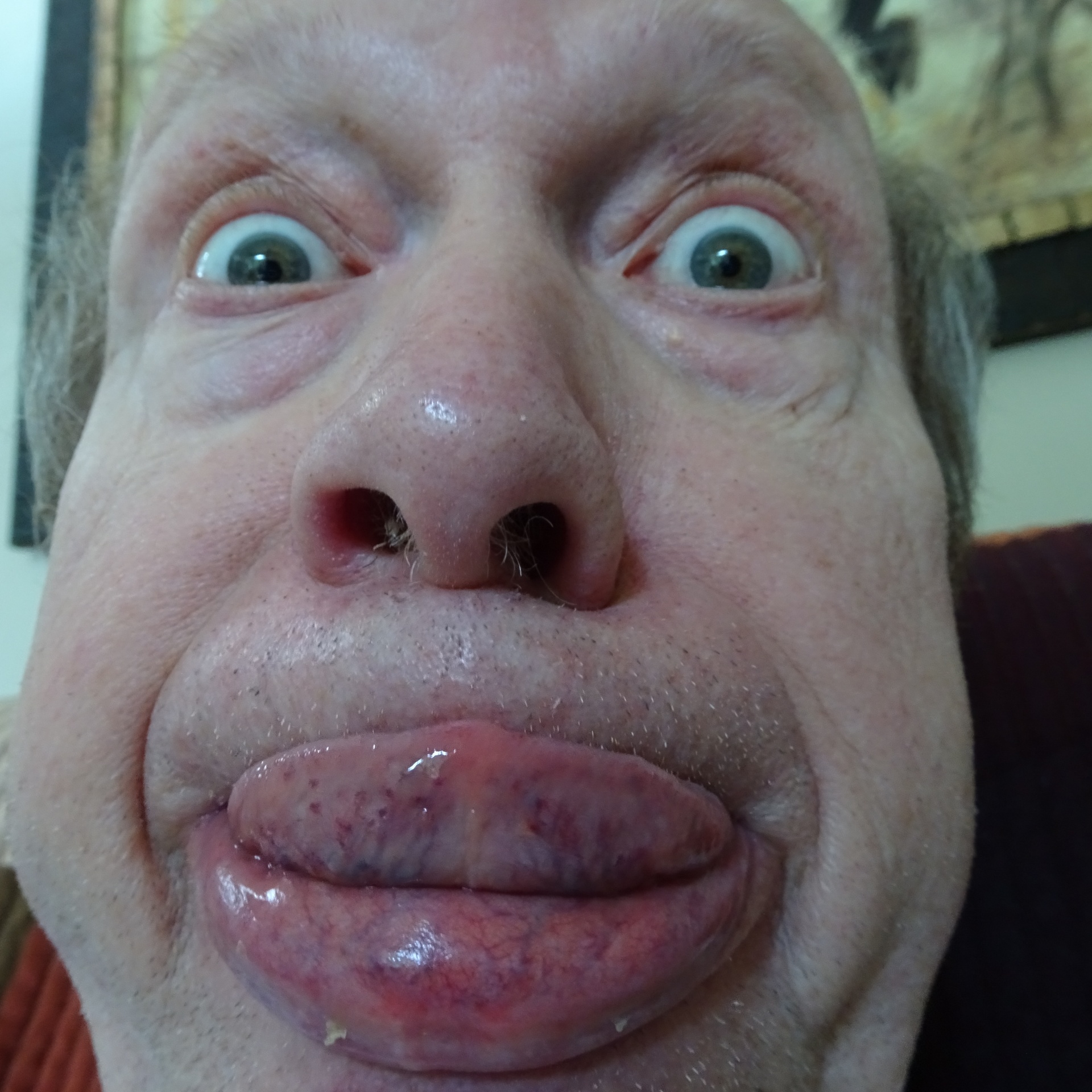 Swollen Lips Free Stock Photo - Public Domain Pictures